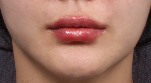 레스틸렌 키스 입술 필러 After