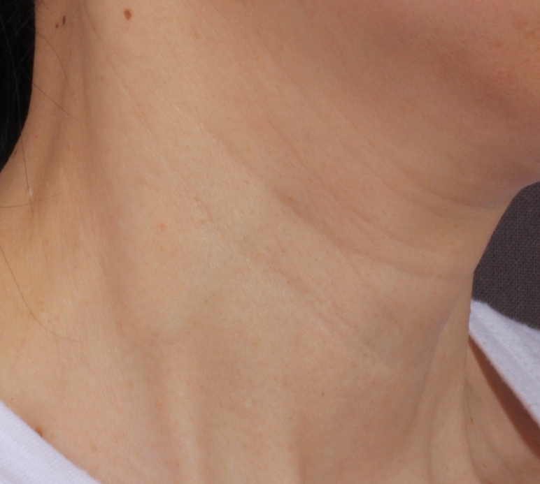 목주름 벨로테로 스킨필러 Before