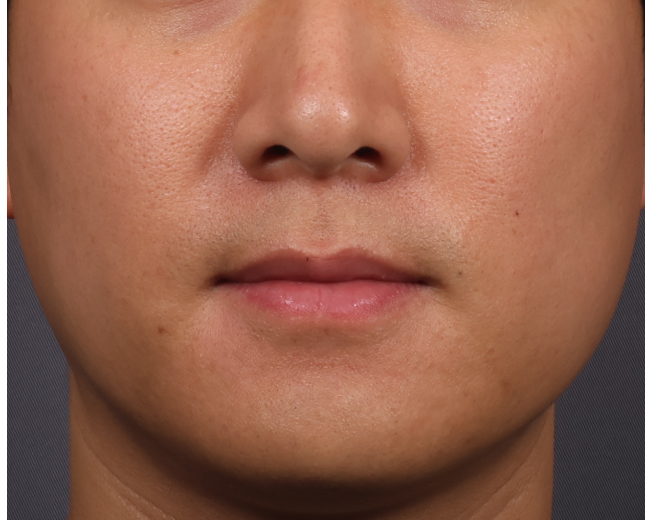 남성 인중 턱수염 제모 (젠틀맥스프로플러스).. After