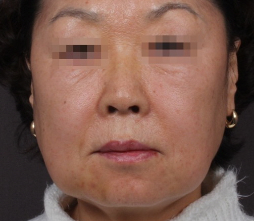 실리프팅 시술 후 사진