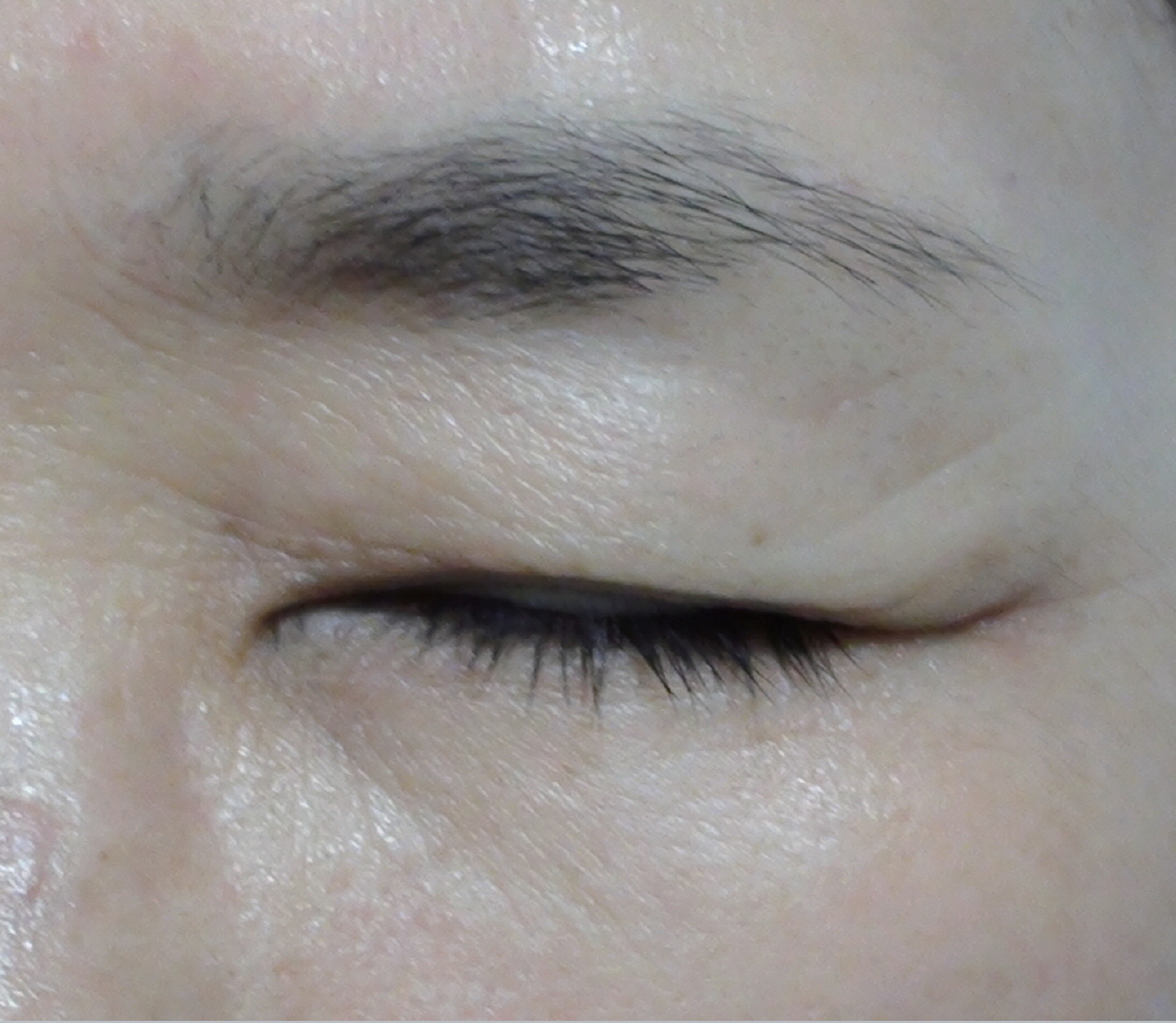 리투오 눈가잔주름 After