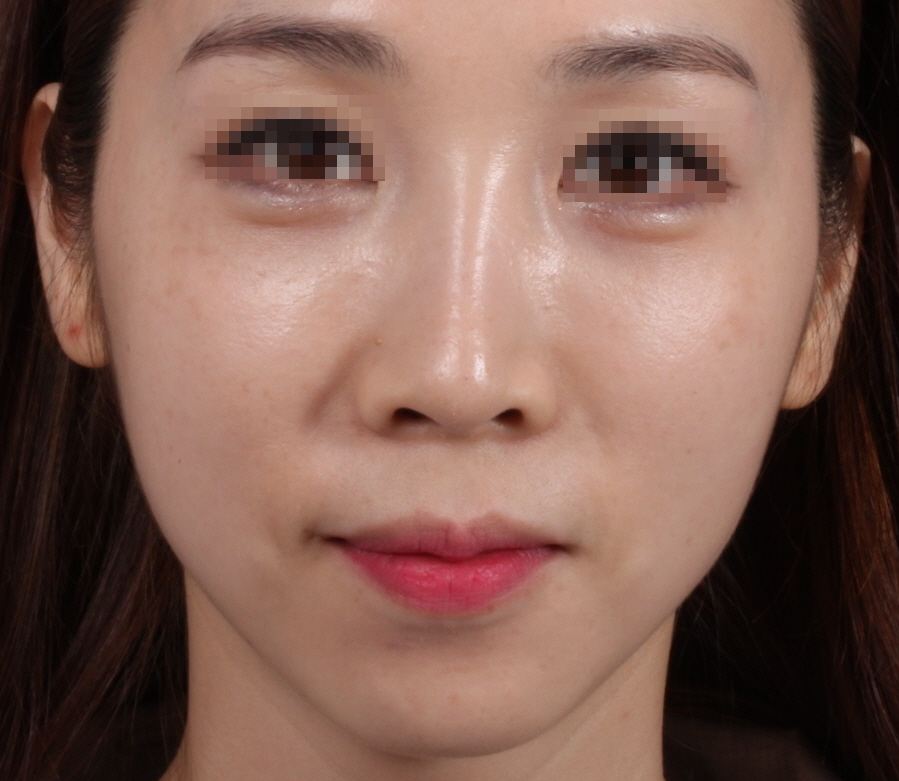 애교 필러  After