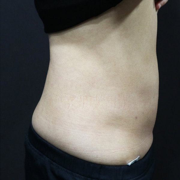 쓱팻 (아랫배) After