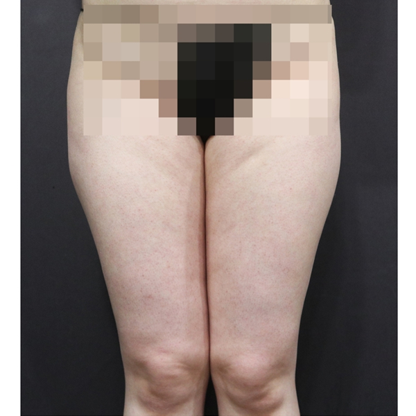 쓱팻 (허벅지) Before