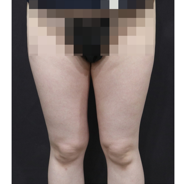 쓱팻 (허벅지) After