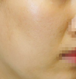 더마블레이트 심부 재생술 시술 후 사진