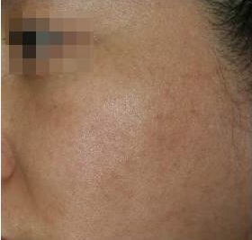 기미 치료 시술 후 사진