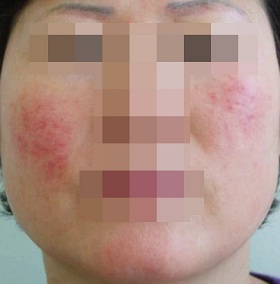 혈관레이저를 이용한 홍조 치료 시술 전 사진