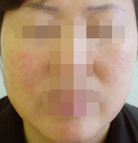 혈관레이저를 이용한 홍조 치료 시술 후 사진