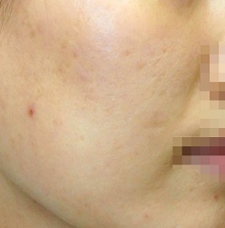 더마블레이트 심부 재생술 시술 전 사진