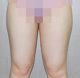 허벅지 지방흡입 시술 전 사진