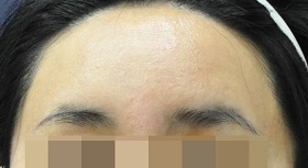 이마 필러 시술 후 사진