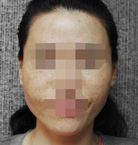 레이저 토닝 시술 전 사진