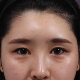 이마필러 시술 후 사진