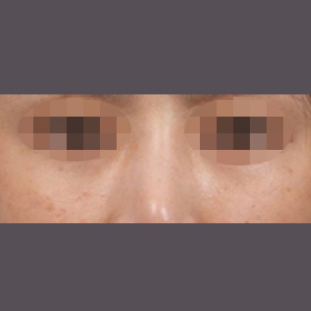 다크써클 교정 시술 후 사진