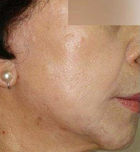 실리프팅 시술 후 사진