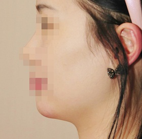 턱끝 필러 시술 후 사진
