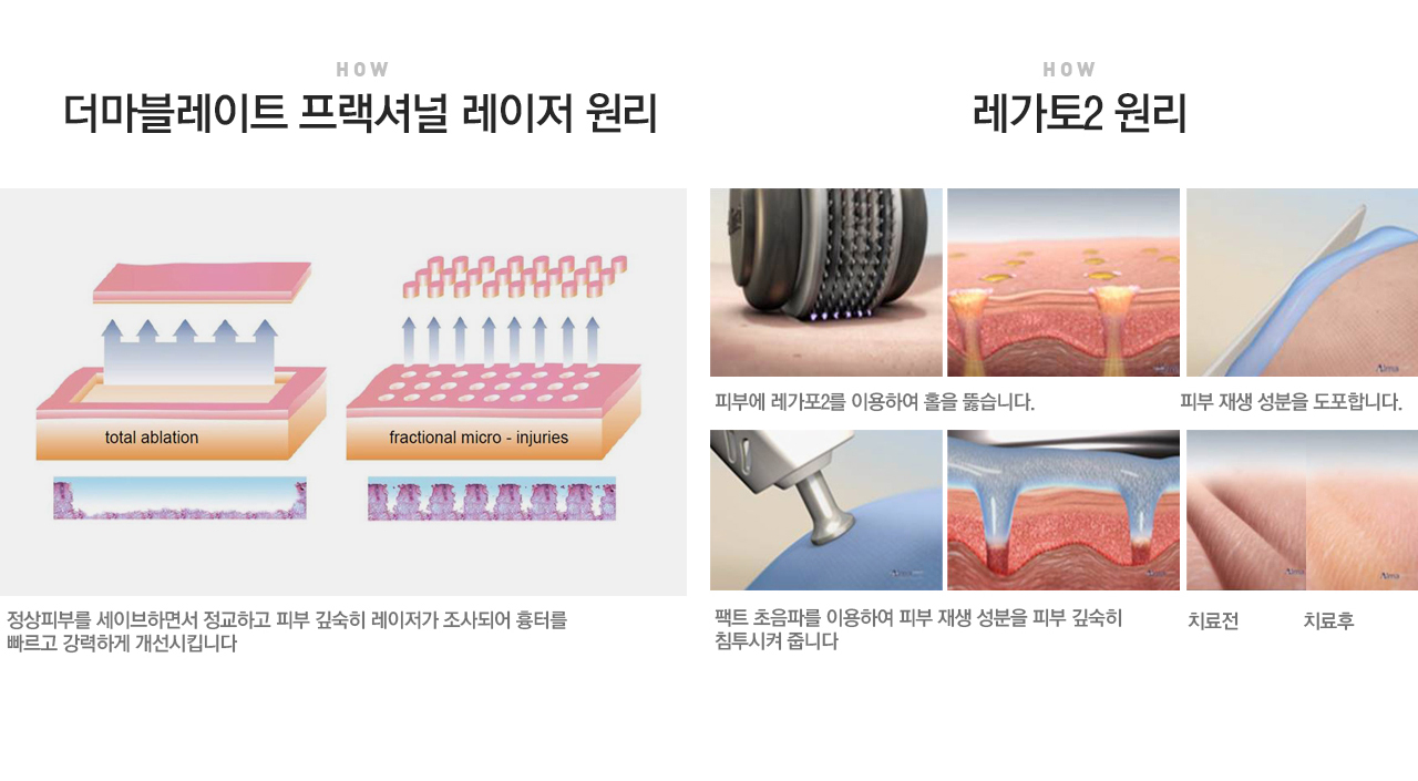 맞춤 흉터 프로그램