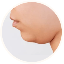 턱끝 볼륨 부족형