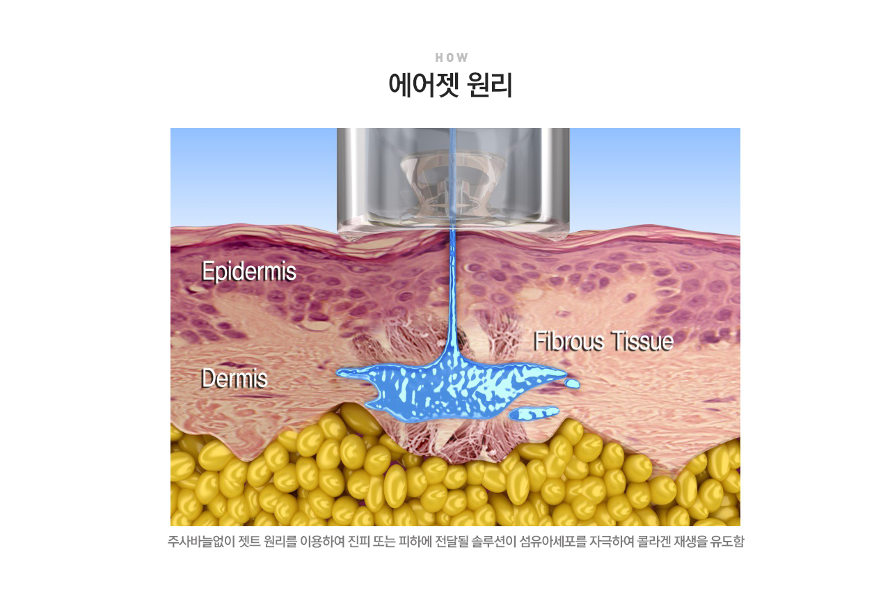 에어젯 리프팅