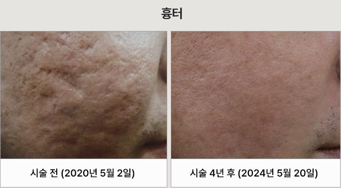 쥬브젠 자가진피재생술