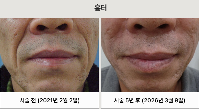 쥬브젠 자가진피재생술