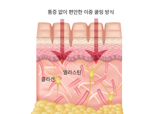 튠 바디 시술 원리